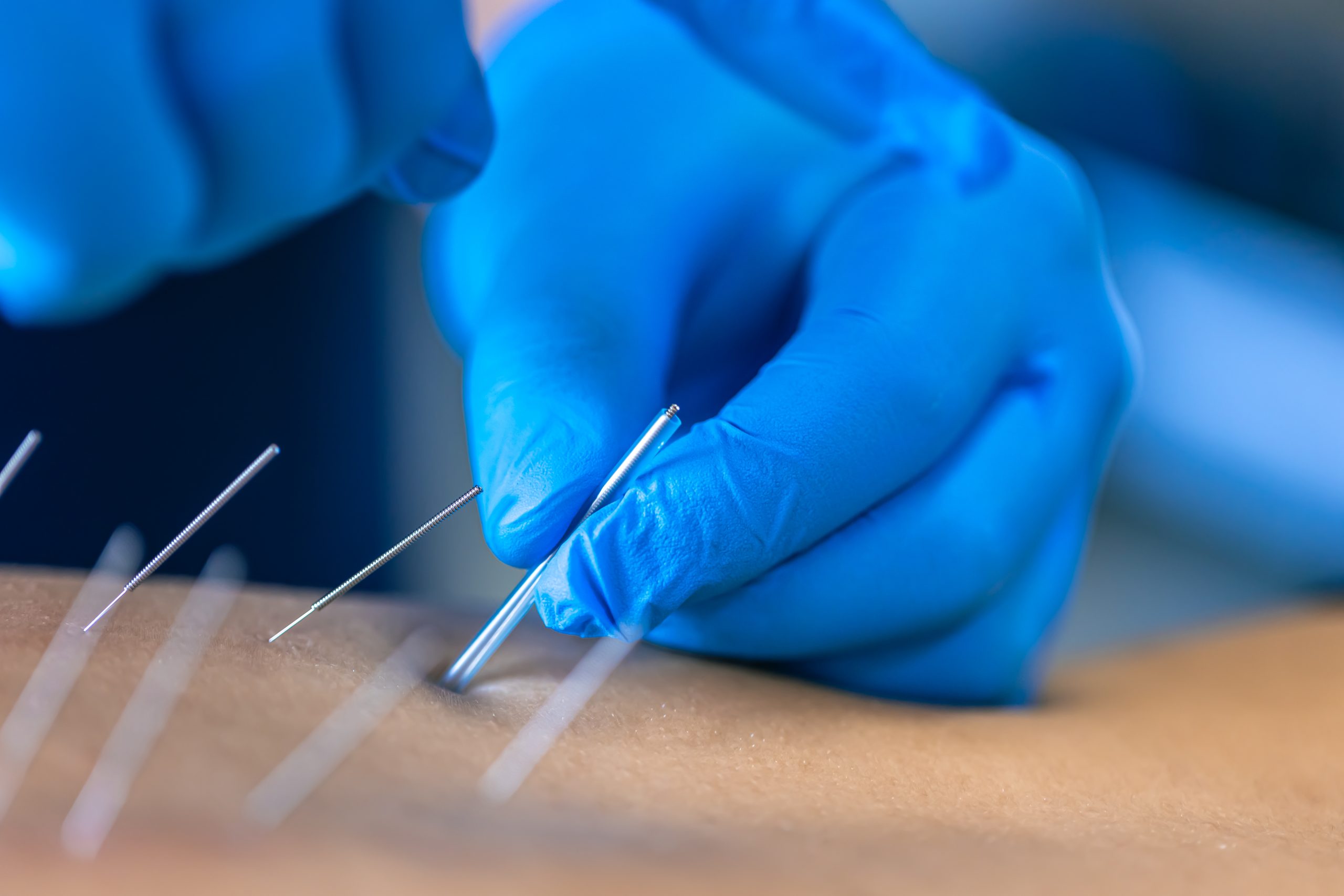 Hijama , Acupuncture , ابر صينية مجموعة الرحمة الطبية Al Rahma Medical Group