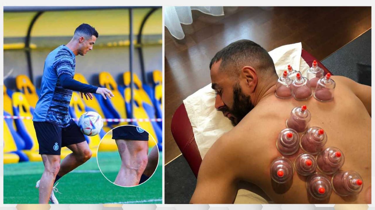 حجامة الرياضيين Hijama Sport