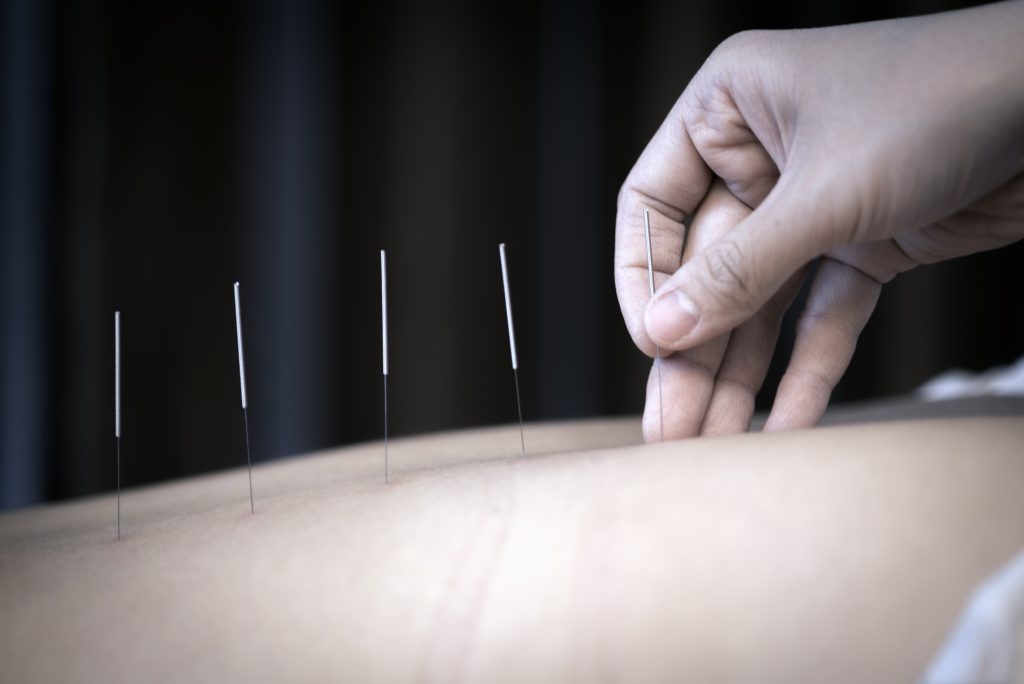 acupuncture