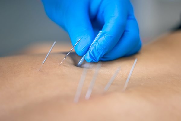 العلاج بالابر الصينية dry needling acupuncture